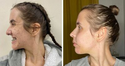 Woman had to relearn how to speak and kiss after getting jaw surgery