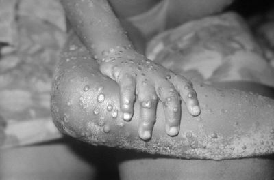 Scotland records 40 total cases of monkeypox amid 'vigilance' warning
