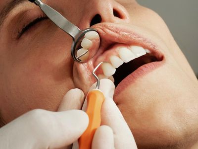 Cannabis & Oral Health Study: Marijuana Smoke Damages Gingival Epithelial Cells, Affecting Our Immune Response As Well