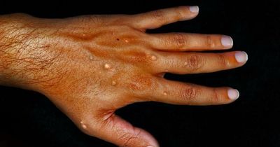 Cases of monkeypox have surged 77% in a week, says World Health Organisation