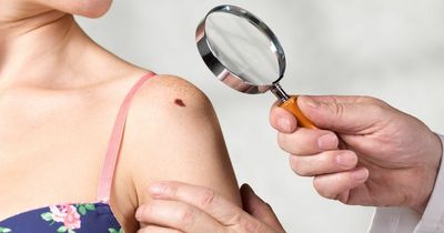 Skin cancer warning signs to look out for as sun hits Ireland