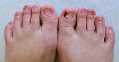 High cholesterol symptom on your toes that warns of dangerously high levels