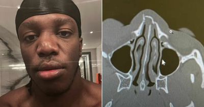 YouTube boxer KSI shows off broken nose weeks out from ring return