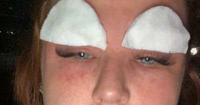 Woman left looking 'like a monster' after eyebrow tint saw her end up in A&E