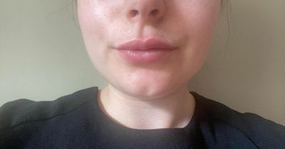 'I got lip fillers after an accident - and I was surprised by the results'