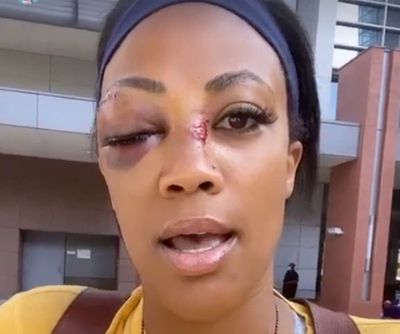 US Olympian Kim Glass reveals horror face injuries after being attacked with pipe in Los Angeles