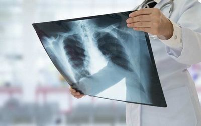 Biotech Can't Conquer the Lungs. Will These Stocks Succeed?