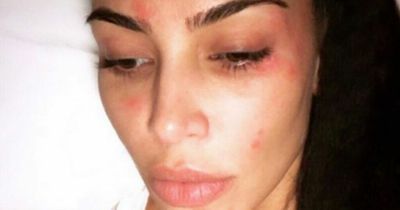 Kim Kardashian's psoriasis battle as fans spot red leg mark in unfiltered bikini pics
