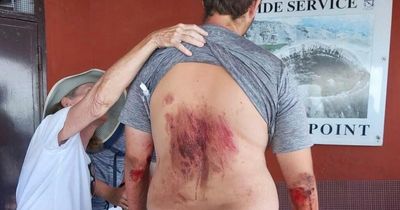 Tourist, 23, shows off bloody injuries after he survives horror fall into Mt Vesuvius