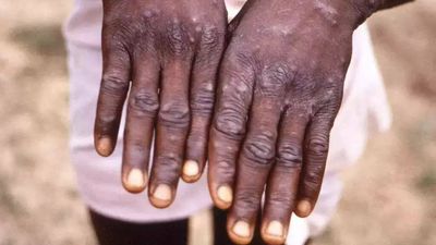 Suspected monkeypox case found in Kerala, samples sent for testing