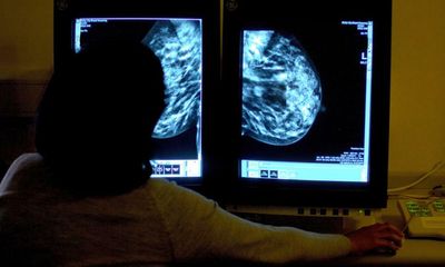 Two breast cancer drugs available on NHS in England after U-turn