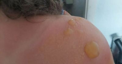 Girl left covered in blisters after playing in mid day sun for just five minutes