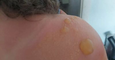 Seven-year-old's skin 'melted within minutes' despite having factor 50 on