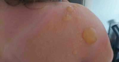 Girl covered in blisters after being in sun for just five minutes in factor 50 suncream