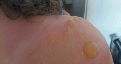 Mum heard daughter's screams as her skin 'melted in minutes'