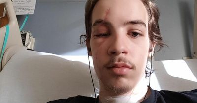 Man's eyeball popped out and he inhaled glass when van hit him as he crossed street