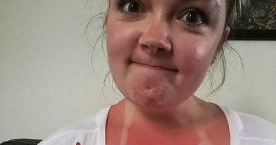 People share 'worst sunburn ever' with one woman having embarrassing criss-cross