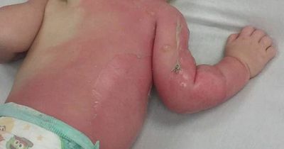 US firefighters share frightening image of child burnt by water from garden hose