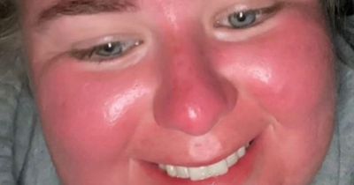 Woman's face 'doubles in size' after spending one hour in sun amid UK heatwave