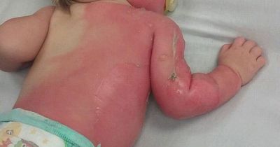 Toddler suffers horror burns after being sprayed with garden hose left in sun