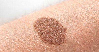 First sign of skin cancer on the body with sunburn a potential cause amid Ireland's hot weather