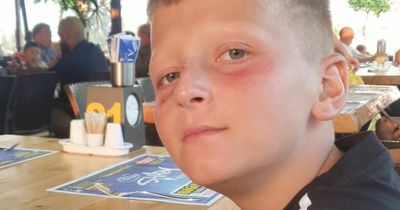 Boy's holiday ruined after getting painful blisters despite using factor 50 suncream