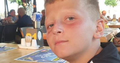 Boy left in 'agony' with painful blisters despite using factor 50 suncream