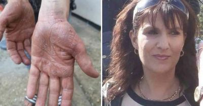 Mum thought her hands were itchy from cleaning products before devastating diagnosis