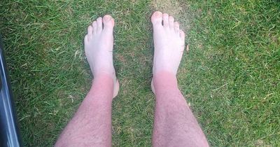 Heatwave horrors: The tan-fails which have left long-lasting reminders of the hottest day