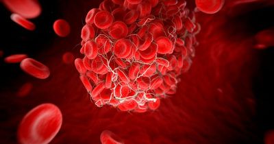 Four blood clot symptoms you should never ignore, including swelling and colour change