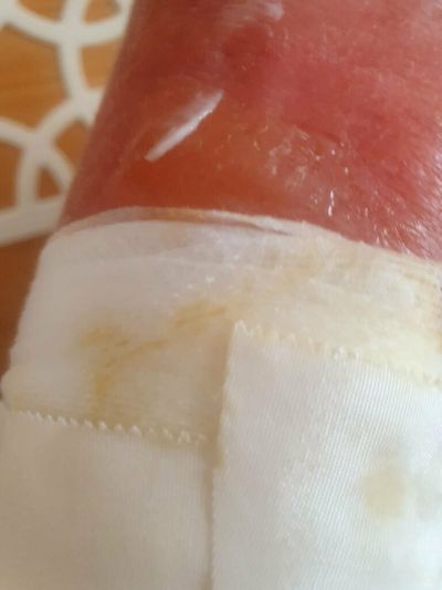 Kid Had His First Vacation In 3 Years Ruined By Extreme Sunburn With Painful Blisters