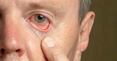 High cholesterol symptoms that appear around your eyes - including skin bumps