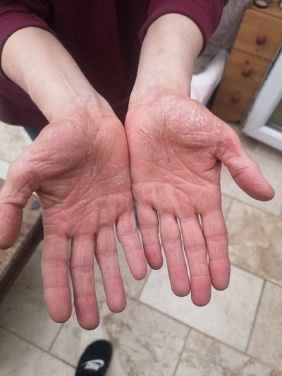 Bile duct cancer symptoms: From itchy and cracked hands to loss of appetite