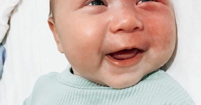 Mum slams trolls who call her a 'monster' for lasering her baby's large birthmark