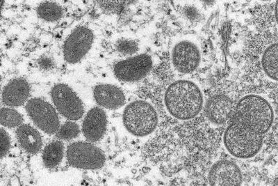 Two children in U.S. diagnosed with monkeypox, officials say