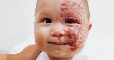 Mum called 'monster' for having laser treatment on baby's facial birthmark