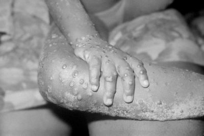 World Health Organisation declares 'global emergency' over monkeypox