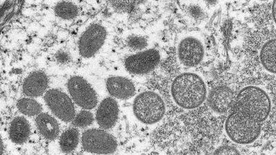 Monkeypox declared global emergency by World Health Organization after surge in cases