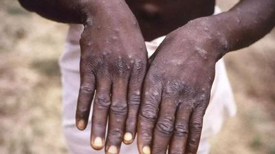 Delhi man with no history of foreign travel tests positive for monkeypox