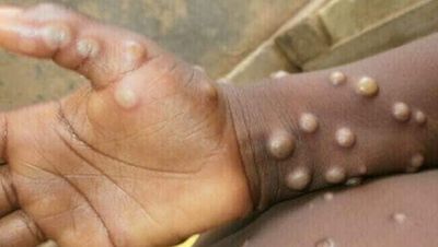 Delhi reports first case of Monkeypox with no travel history