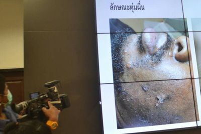 Nigerian monkeypox patient can stay in Cambodia, says Anutin