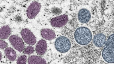 Monkeypox virus: What are the symptoms, how does it spread and is there a cure?
