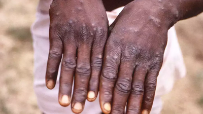 Patna: Experts say people should take precautions against monkeypox