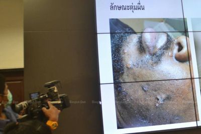 Monkeypox patient can stay in Cambodia, says Anutin
