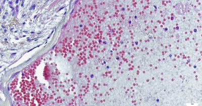 The unsuspecting signs of Monkeypox as global health emergency declared and cases found in women and children