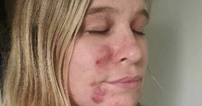 Mum felt 'like monster' and hid her face from daughter when she was struck with cystic acne post Covid