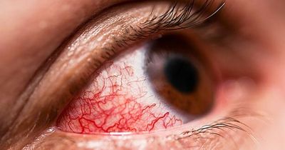 Deadly 'nose bleed' disease which kills up to a third of patients reaches Europe