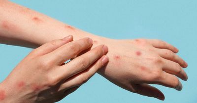 Monkeypox and Chickenpox key differences – main symptoms and how to tell them apart
