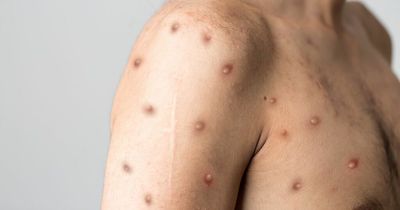 How does monkeypox spread and is it dangerous as virus declared global health emergency