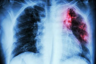 UK lung disease deaths ‘being caused by low pay and damp housing’